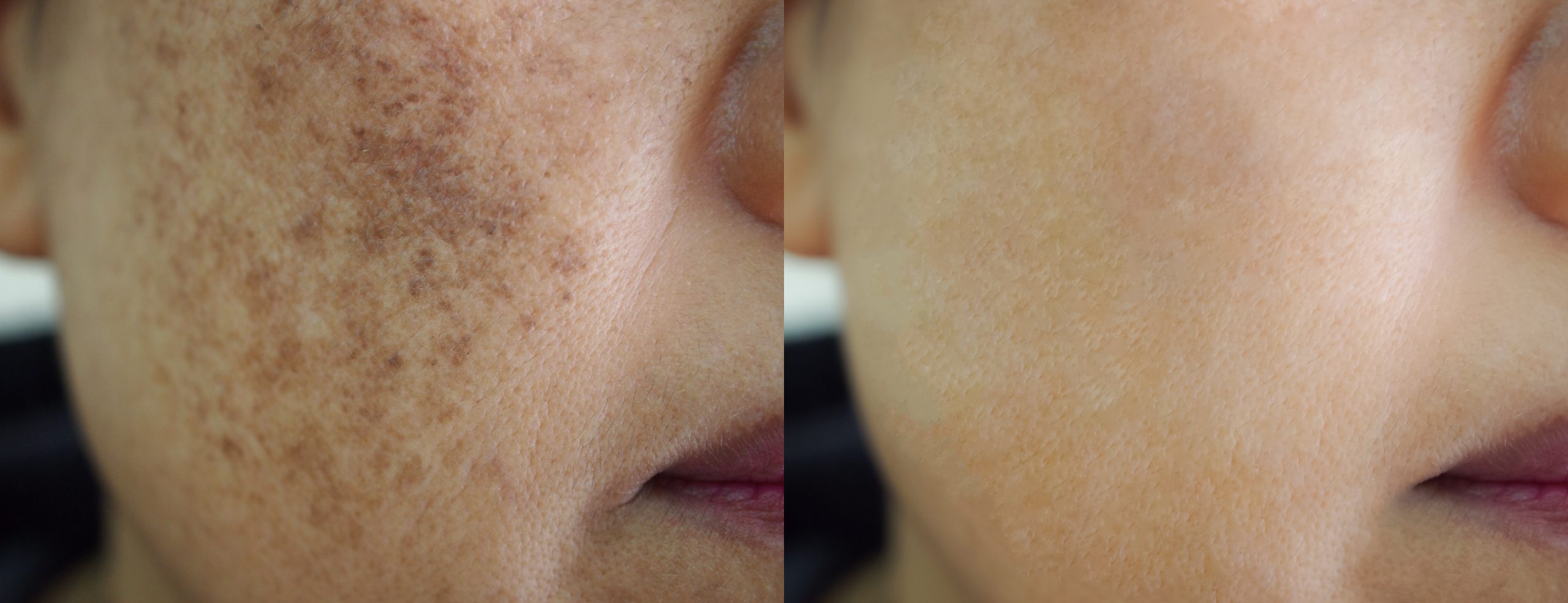 Pigmentation Reduction & Removal