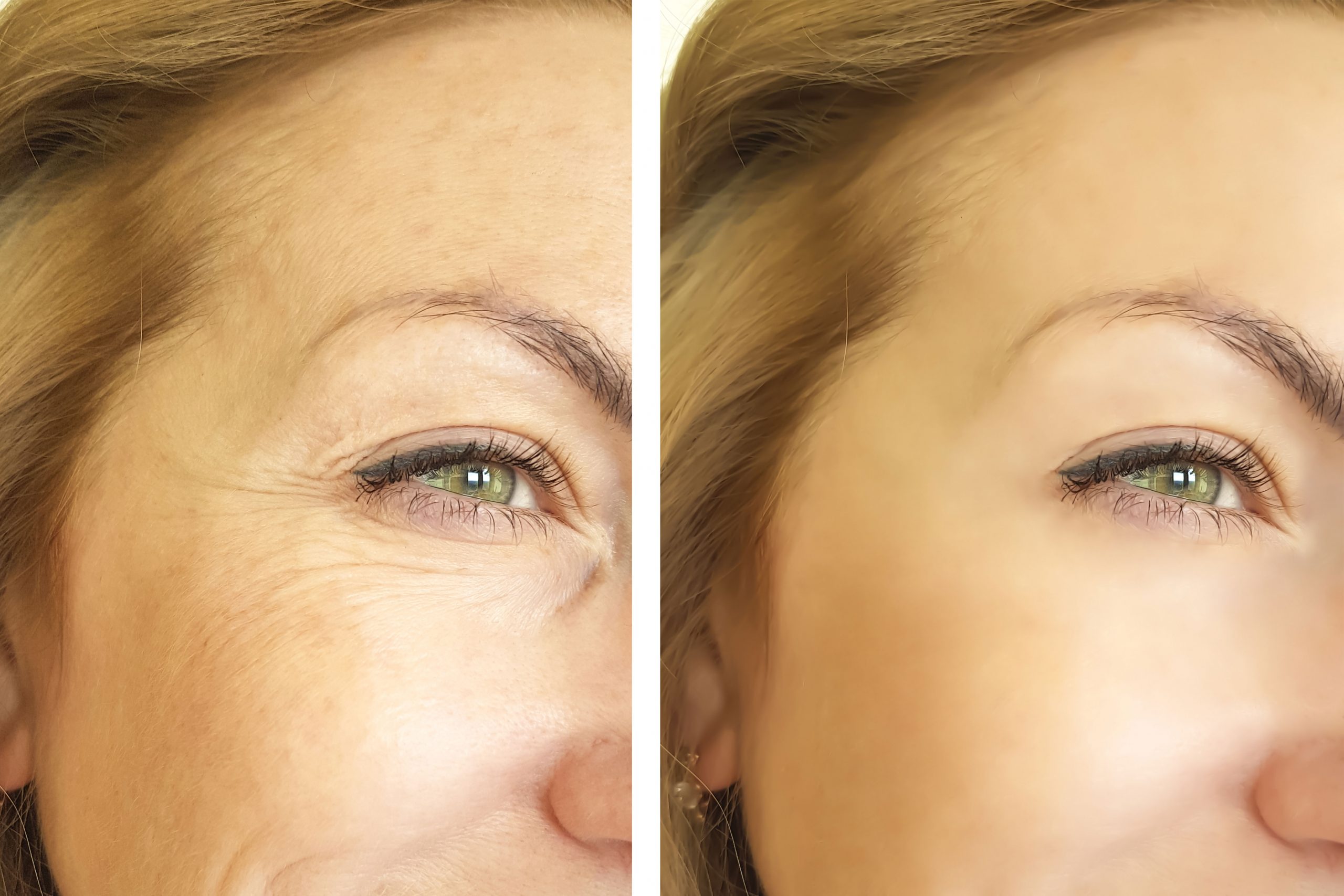 Fibroblast (wrinkle removal)